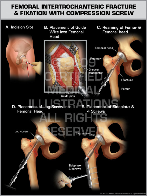 Exhibit of Femoral Intertrochanteric Fracture & Fixation with Compression Screw.