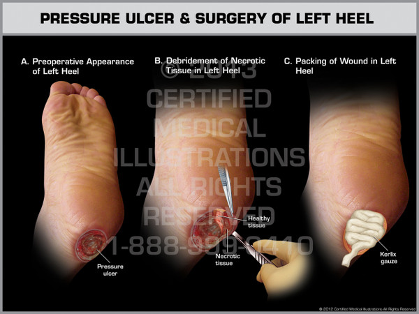 Exhibit of Pressure Ulcer & Surgery of Left Heel.