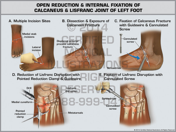 Exhibit of Open Reduction & Internal Fixation of Calcaneus & Lisfranc Joint of Left Foot.