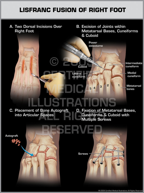 Exhibit of Lisfranc Fusion of Right Foot.