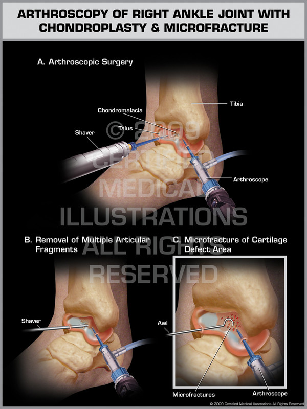 Exhibit of Arthroscopy of Right Ankle Joint with Chondroplasty & Microfracture.