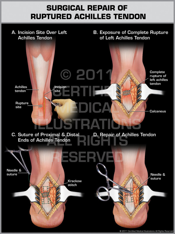 Exhibit of Surgical Repair of Ruptured Achilles Tendon.