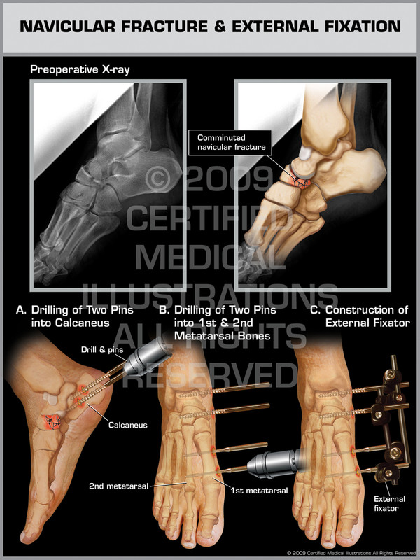 Exhibit of Navicular Fracture & External Fixation.