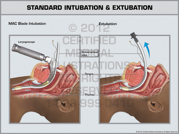 Exhibit of Standard Intubation & Extubation.