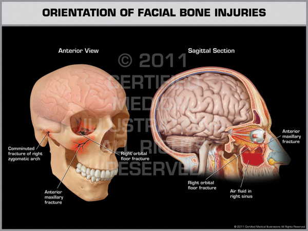 Exhibit of Orientation of Facial Bone Injuries.