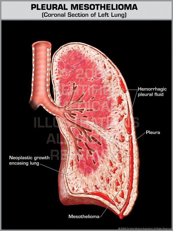 Exhibit of Pleural Mesothelioma.