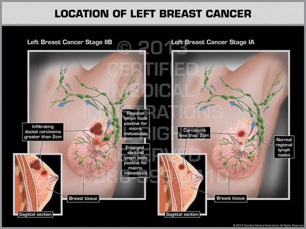 Exhibit of Location of Left Breast Cancer.