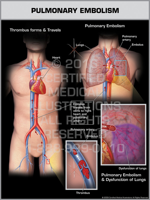 Exhibit of Pulmonary Embolism Male.