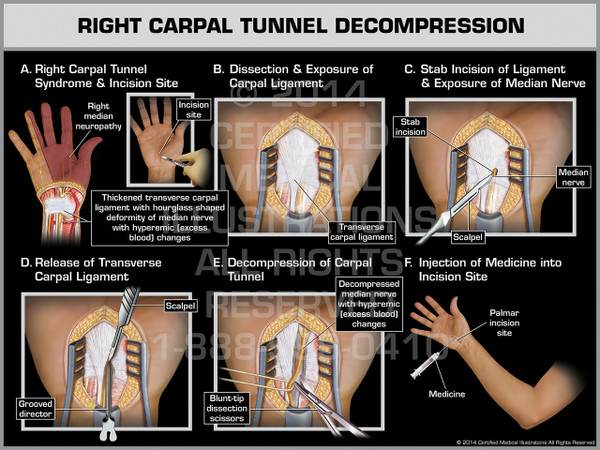 Exhibit of Right Carpal Tunnel Decompression.