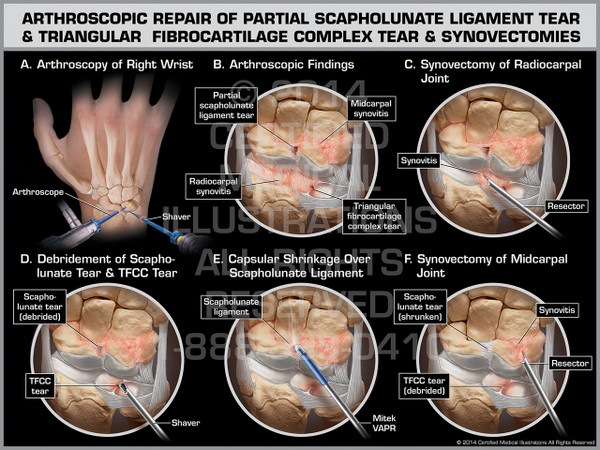 Exhibit of Arthroscopic Repair of Partial Scapholunate Ligament Tear & Triangular Fibrocartilage Complex Tear & Synovectomies.