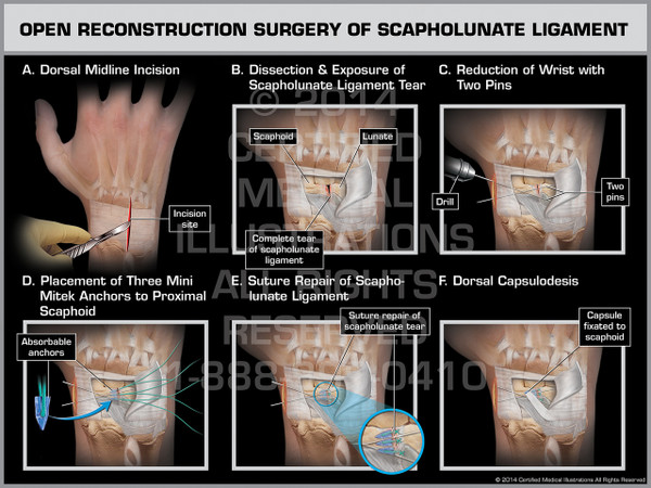Exhibit of Open Reconstruction Surgery of Scapholunate Ligament.