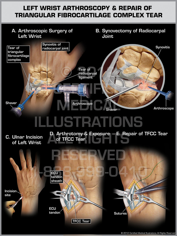 Exhibit of Left Wrist Arthroscopy & Repair of Triangular Fibrocartilage Complex Tear.