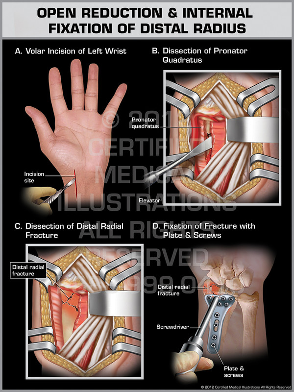 Exhibit of Open Reduction & Internal Fixation of Distal Radius.