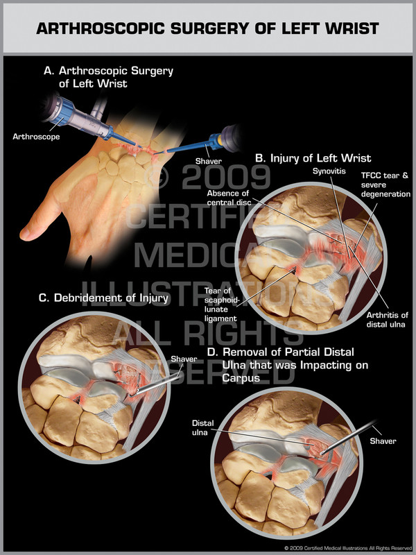 Exhibit of Arthroscopic Surgery of Left Wrist.