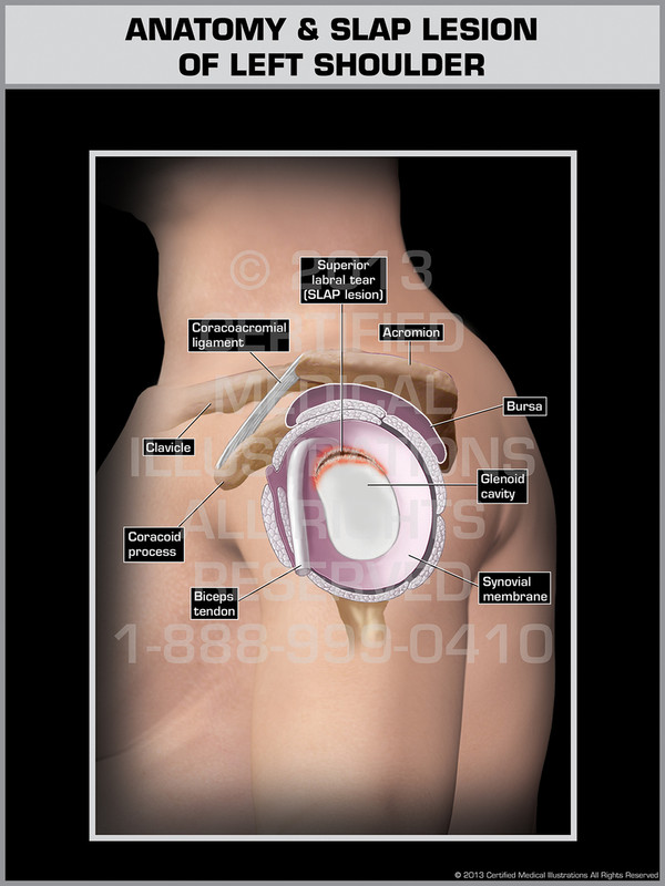 Exhibit of Anatomy & Slap Lesion of Left Shoulder.