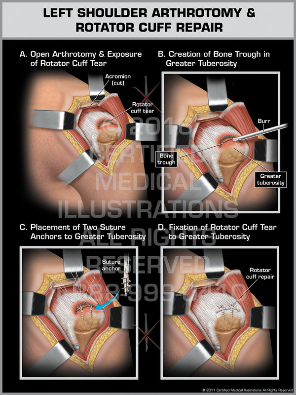 Exhibit of Left Shoulder Arthrotomy & Rotator Cuff Repair.