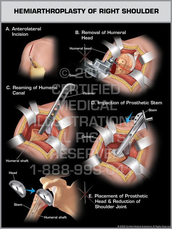 Exhibit of Hemiarthroplasty of Right Shoulder.