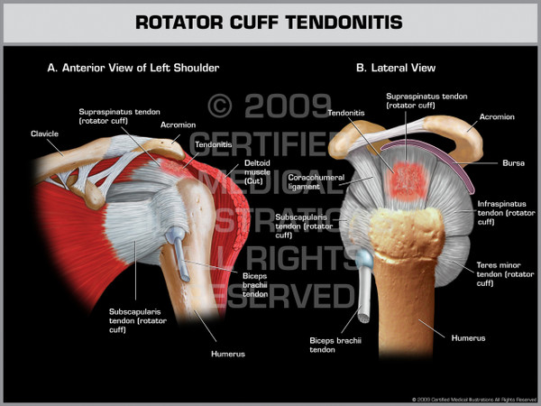 Exhibit of Rotator Cuff Tendonitis - Left.