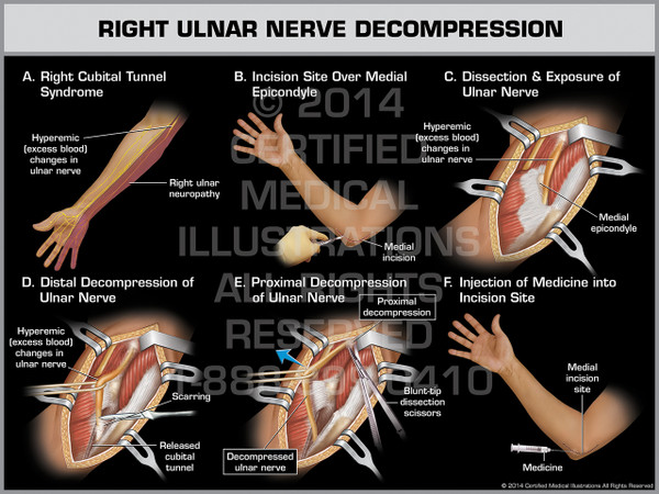 Right Ulnar Nerve Decompression