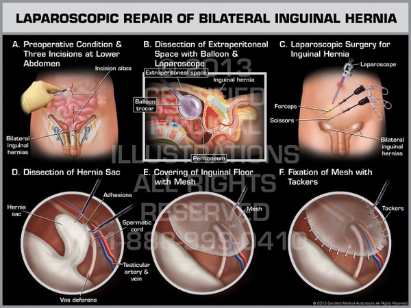 Exhibit of Laparoscopic Repair of Bilateral Inguinal Hernia.