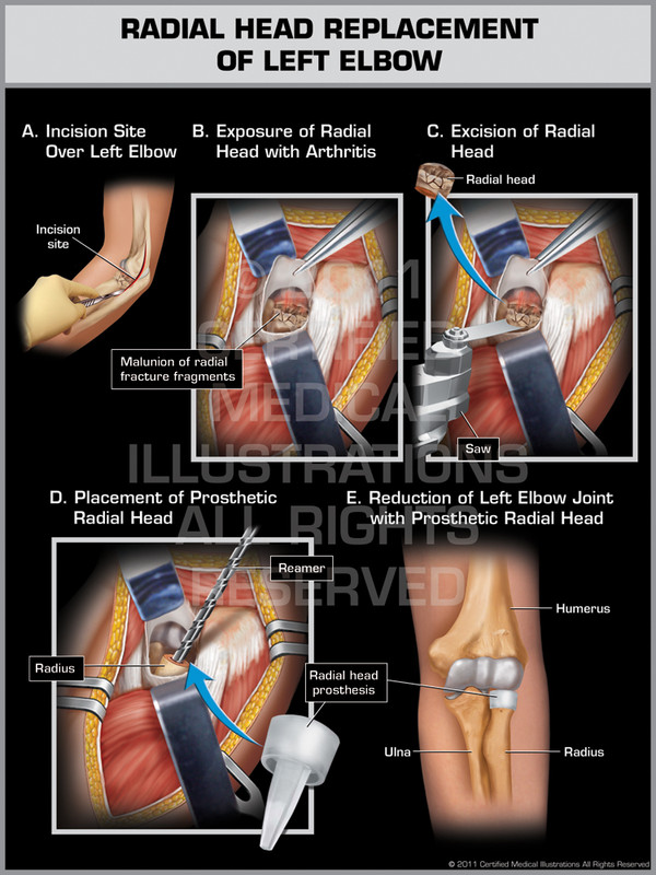 Radial Head Replacement of Left Elbow
