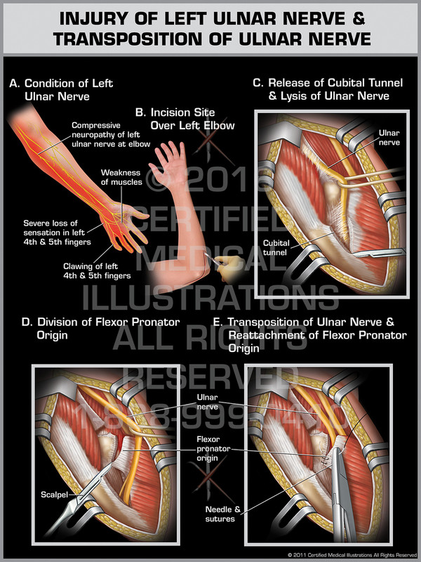 Injury of Left Ulnar Nerve & Transposition of Ulnar Nerve