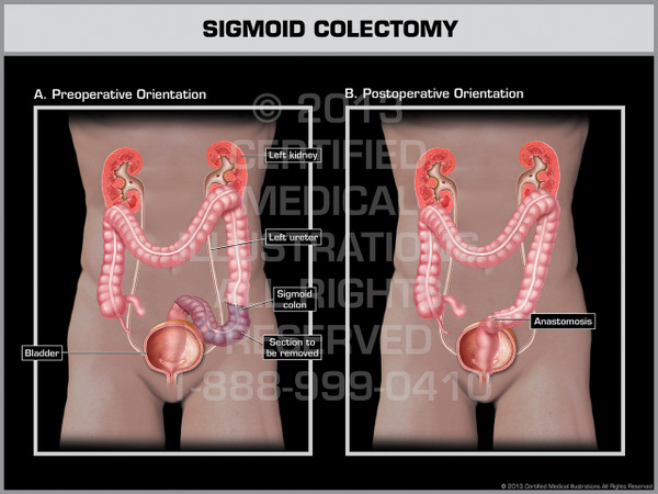 Exhibit of Sigmoid Colectomy.