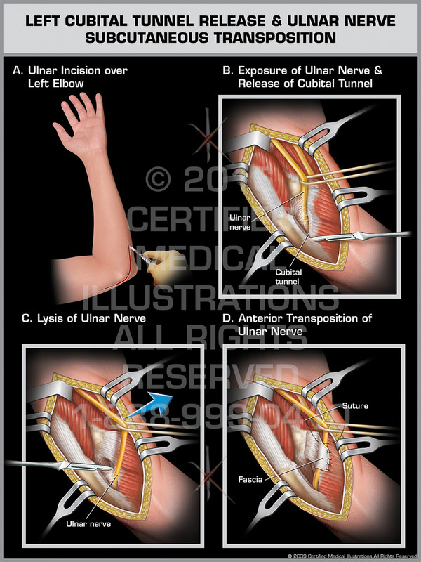 Left Cubital Tunnel Release & Ulnar Nerve Subcutaneous Transposition