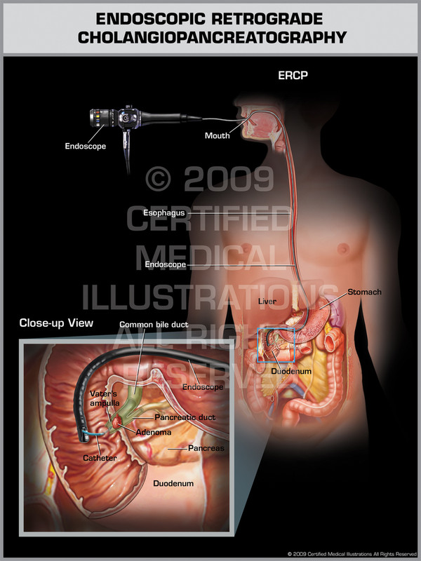 Endoscopic Retrograde Cholangiopancreatography (Male)