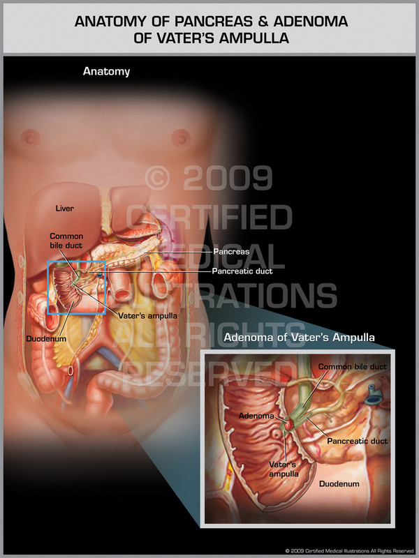 Anatomy of Pancreas and Adenoma of Vater's Ampulla