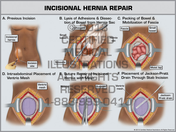 Incisional Hernia Repair