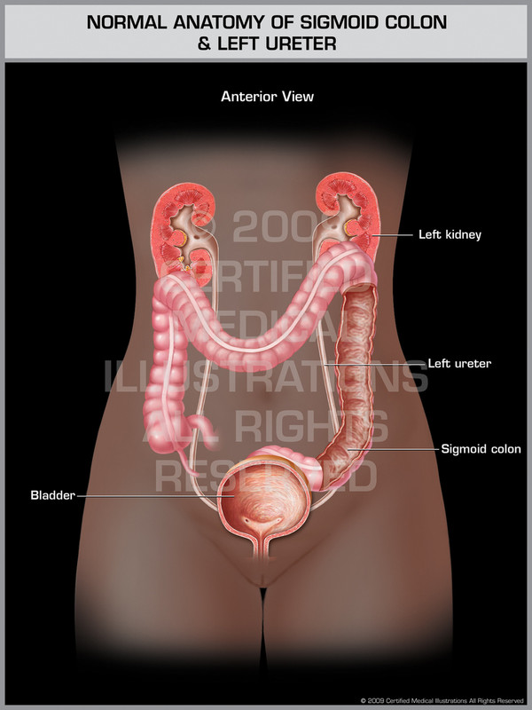 Normal Anatomy of Sigmoid Colon & Left Ureter (Female)