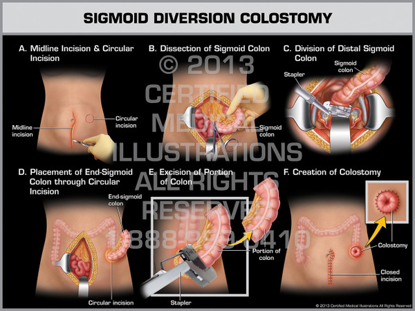 Exhibit of Sigmoid Diversion Colostomy (Female).
