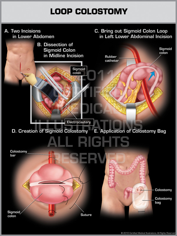 Exhibit of Loop Colostomy.