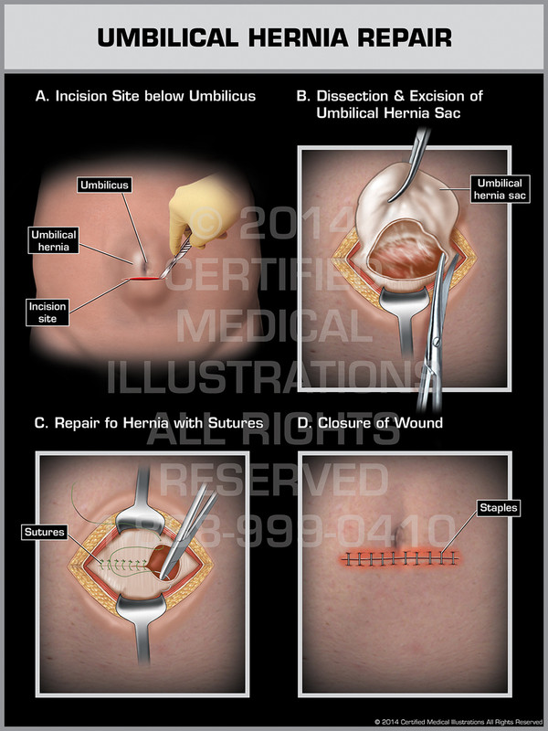 Umbilical Hernia Repair