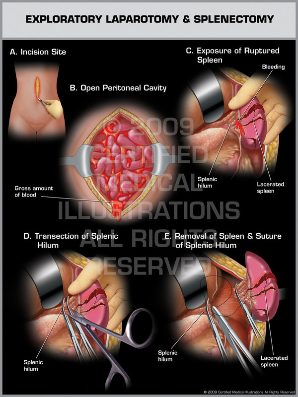 Exhibit of Exploratory Laparotomy & Splenectomy. Exhibit of Exploratory Laparotomy & Splenectomy.