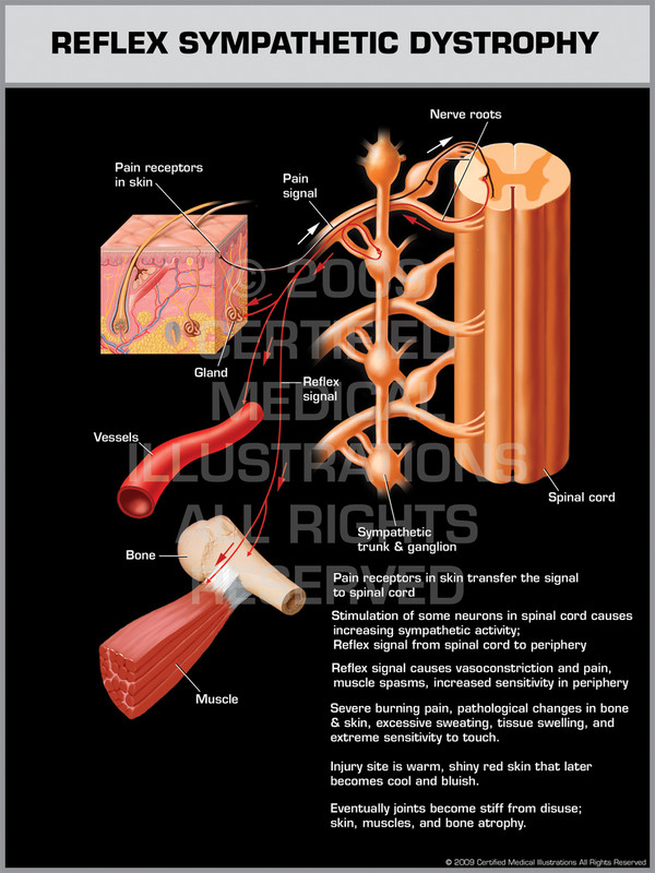 Reflex Sympathetic Dystrophy (RSD)