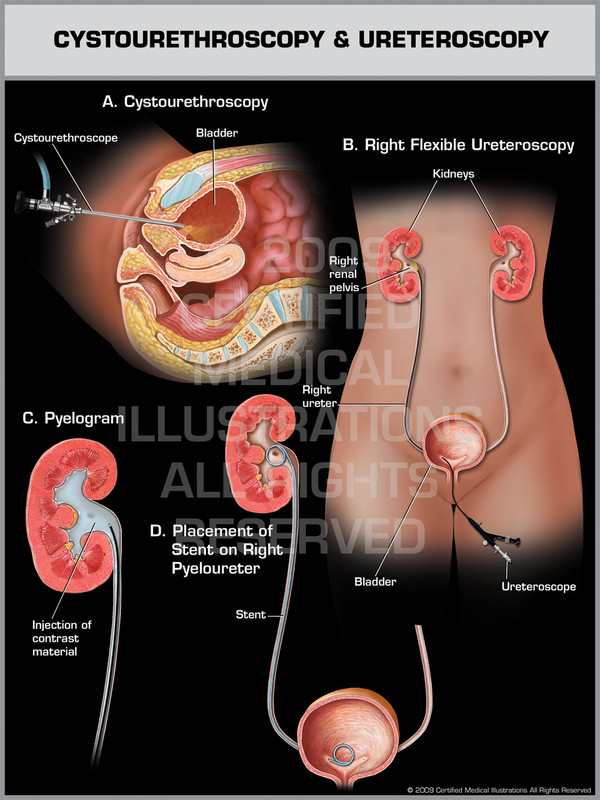 Cystourethroscopy & Ureteroscopy