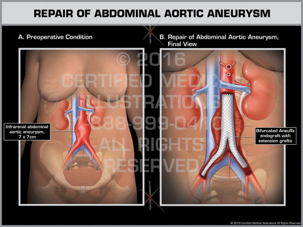 Exhibit of Repair of Abdominal Aortic Aneurysm - Print Quality Instant Download