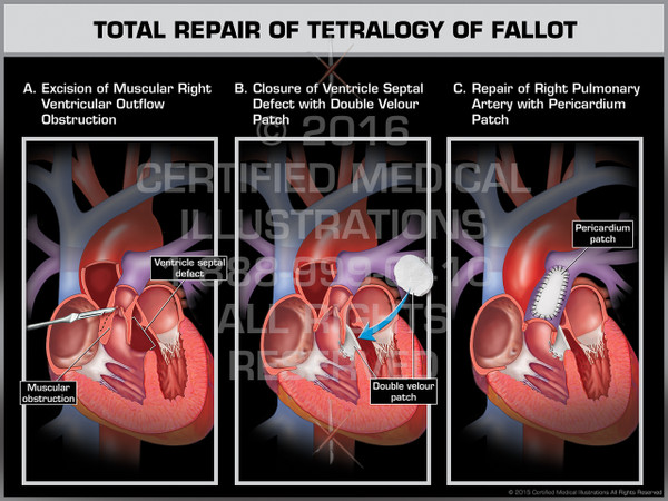 Exhibit of Total Repair of Tetralogy of Fallot