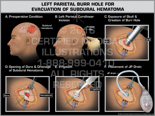 Exhibit of Left Parietal Burr Hole for Evacuation of Subdural Hematoma