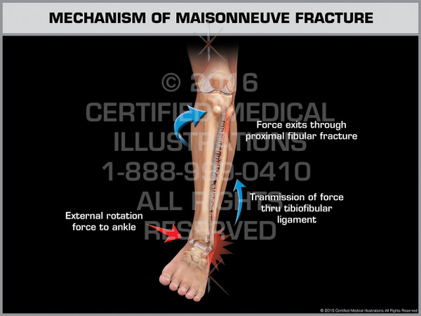 Exhibit of Mechanism of Maisonneuve Fracture - Print Quality Instant Download