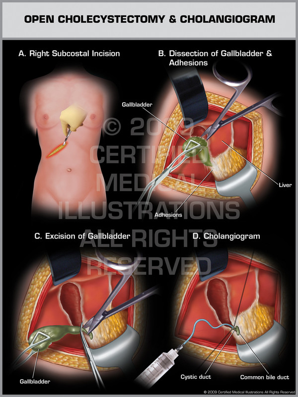 Open Cholecystectomy & Cholangiogram