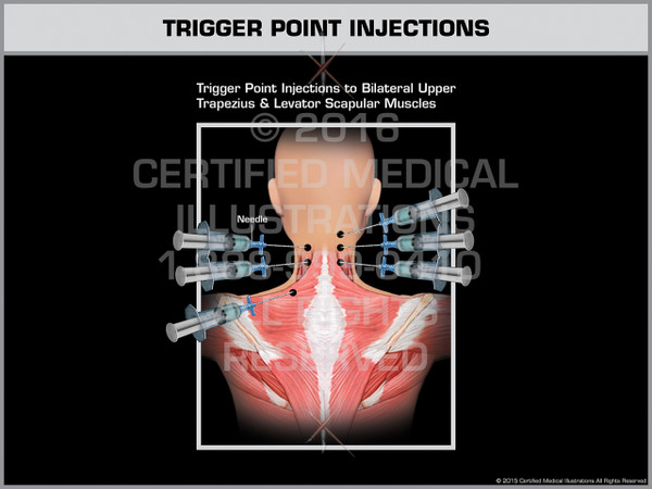 Exhibit of Trigger Point Injections