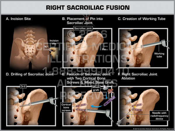 Exhibit of Right Sacroiliac Fusion