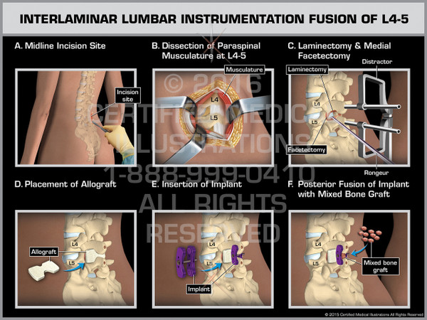 Exhibit of Interlaminar Lumbar Instrumentation Fusion of L4-5