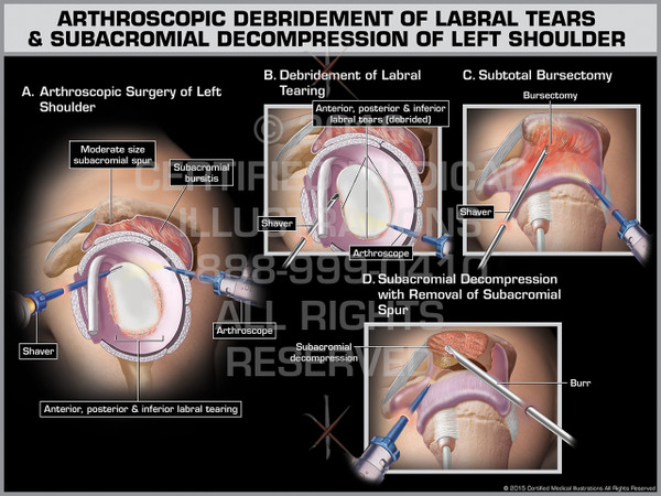 Exhibit of Arthroscopic Debridement of Labral Tears & Subacromial Decompression of Left Shoulder