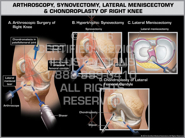 Exhibit of Arthroscopy, Synovectomy, Lateral Meniscectomy & Chondroplasty of Right Knee