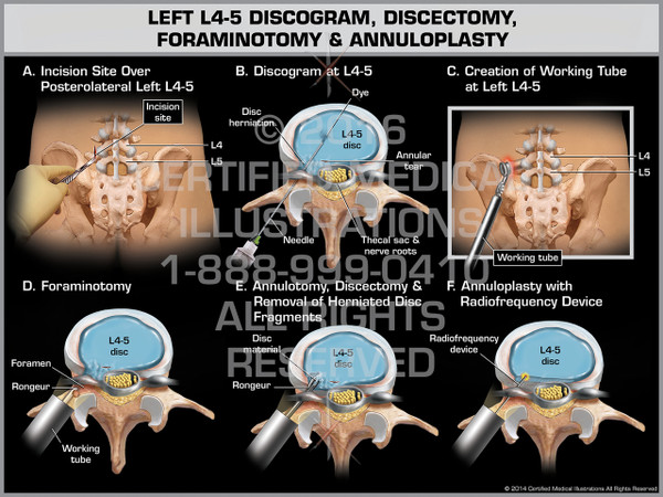 Exhibit of Left L4-5 Discogram, Discectomy, Foraminotomy & Annuloplasty - Print Quality Instant Download