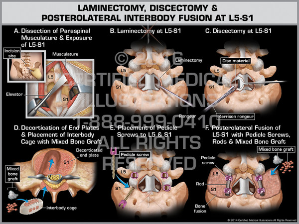 Exhibit of Laminectomy, Discectomy & Posterolateral Interbody Fusion at L5-S1 - Print Quality Instant Download
